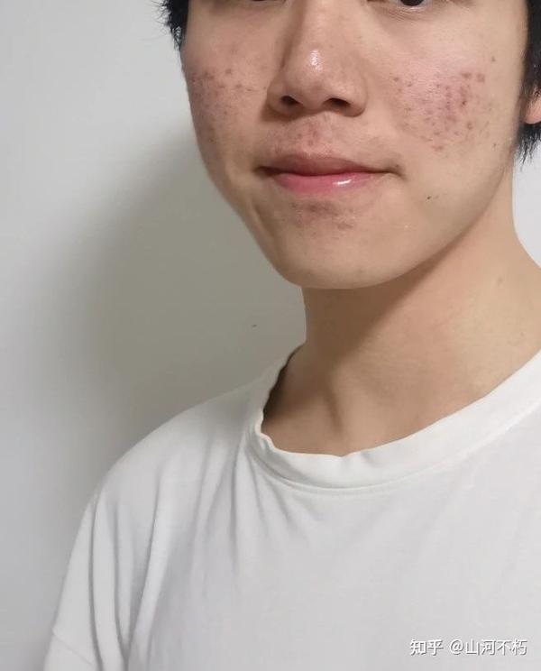 三,帅哥的脸上就不能有痘痘