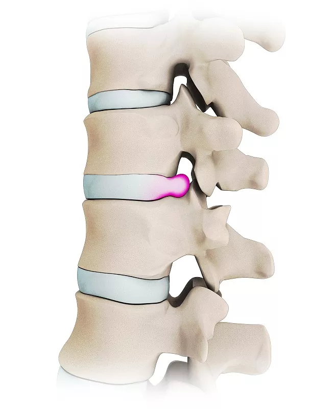 腰椎间盘突出压迫马尾神经为什么会腿麻
