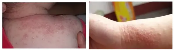 经过临床观察,很多婴幼儿牛奶过敏以特异性皮炎或胃肠表现为特征,应