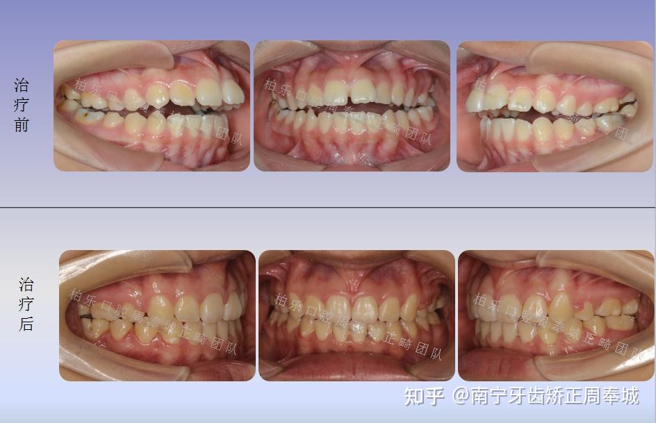 南寧牙齒矯正周醫生牙齒無法正常咬合治療案例