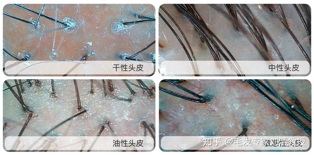 瘙痒、异味、长痘、出油、刺痛…… 你的头皮还好吗？ - 知乎