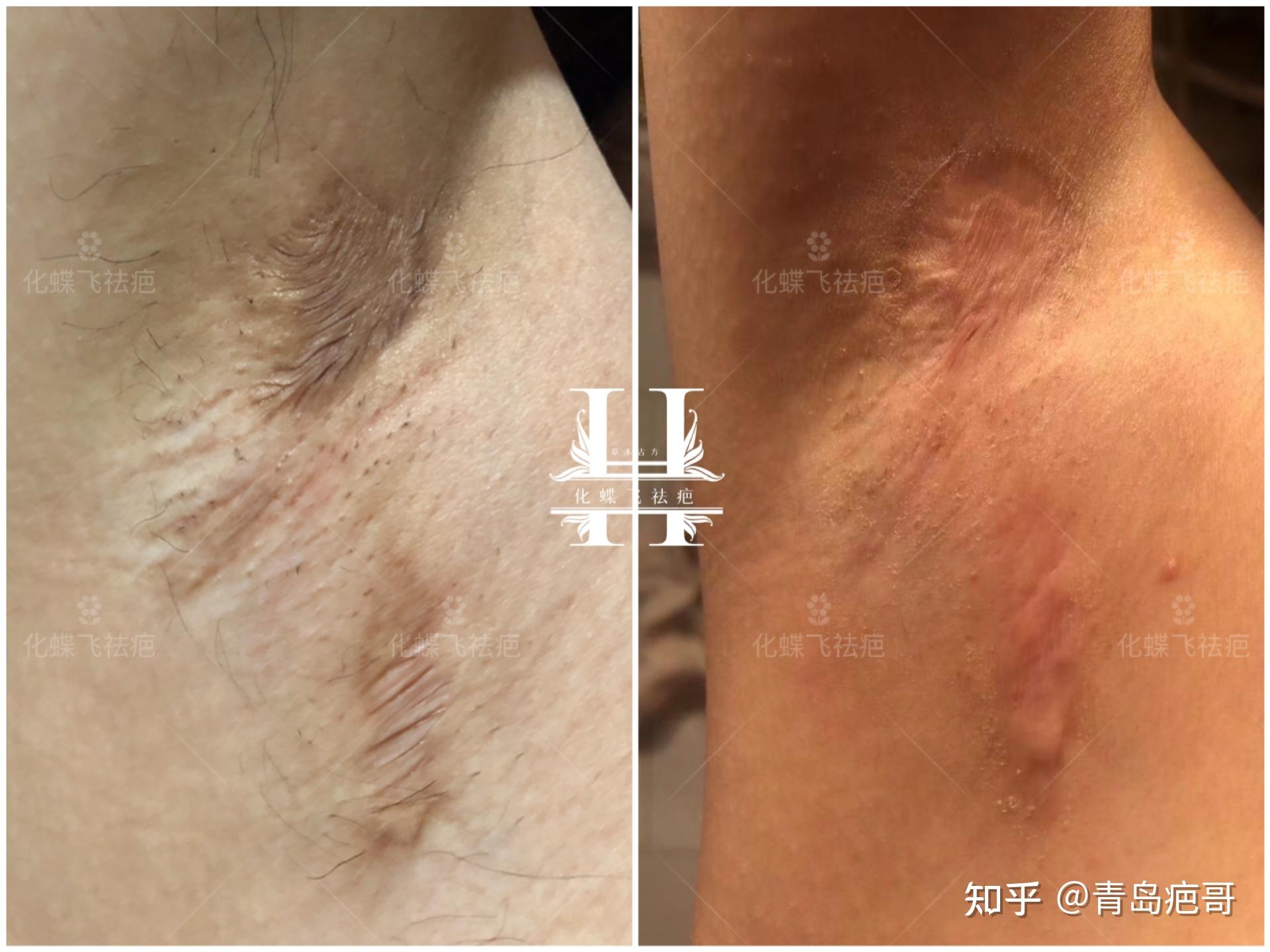 七八年的腋下手术疤痕
