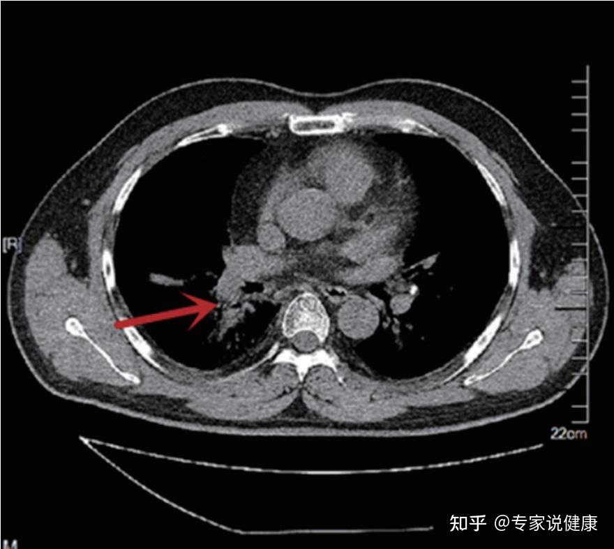 由於李先生診斷結果為廣泛期小細胞肺癌,且已經出現轉移,因此聯合化療