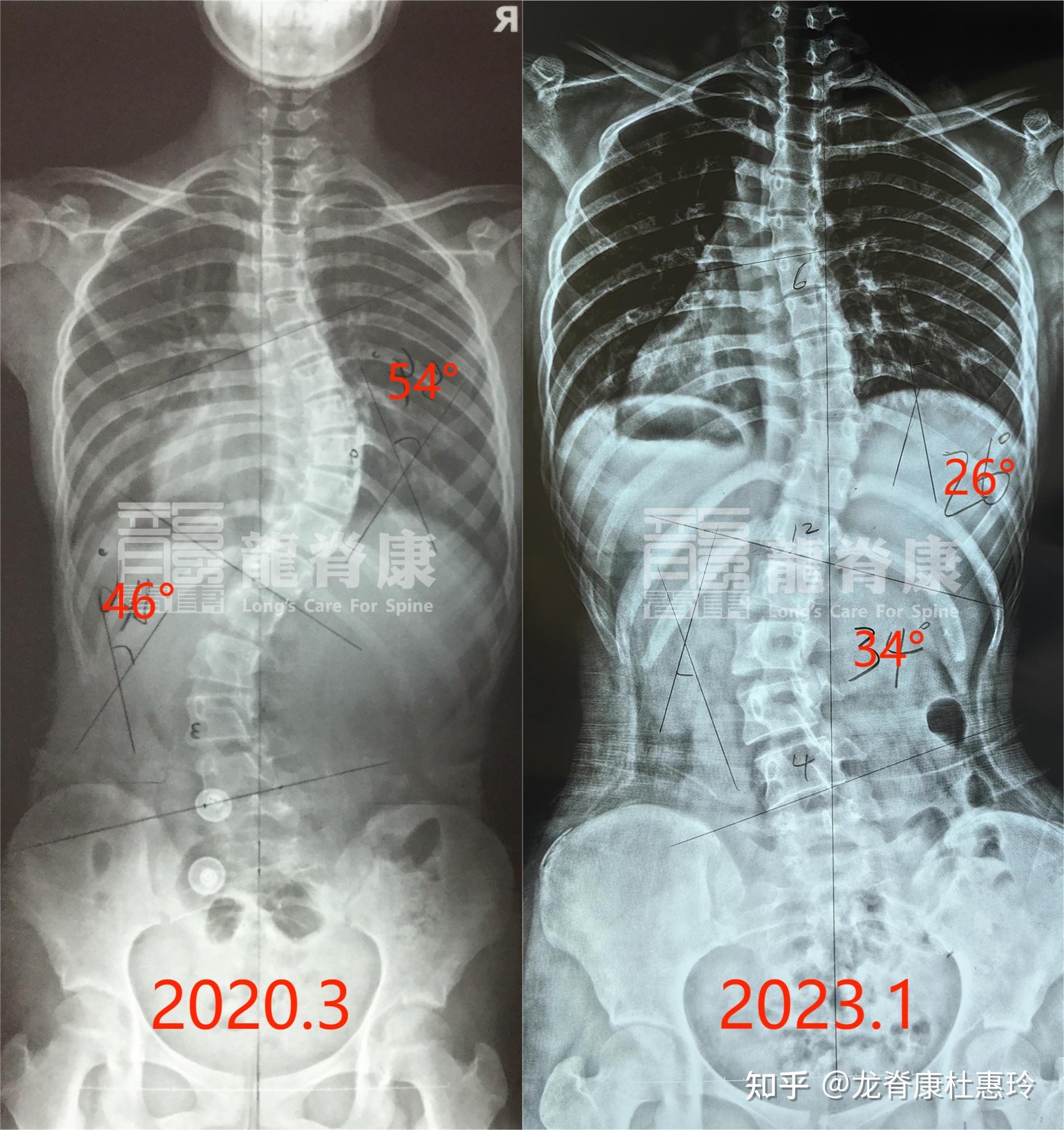 17岁侧弯女孩,矫正三年后度数减少28°,剃刀背减少14°,体表改善 - 知乎