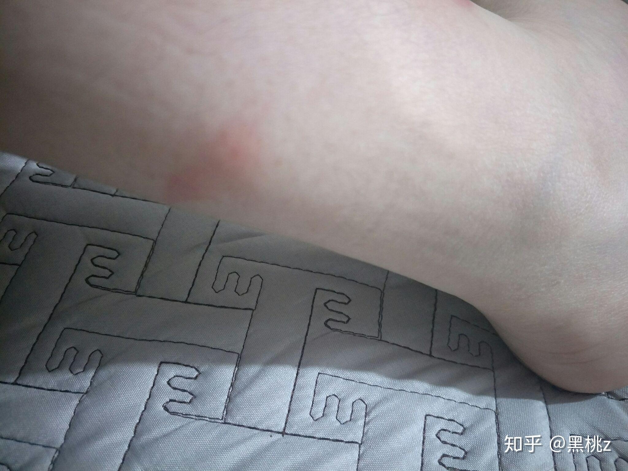 不知道被什么东西咬的