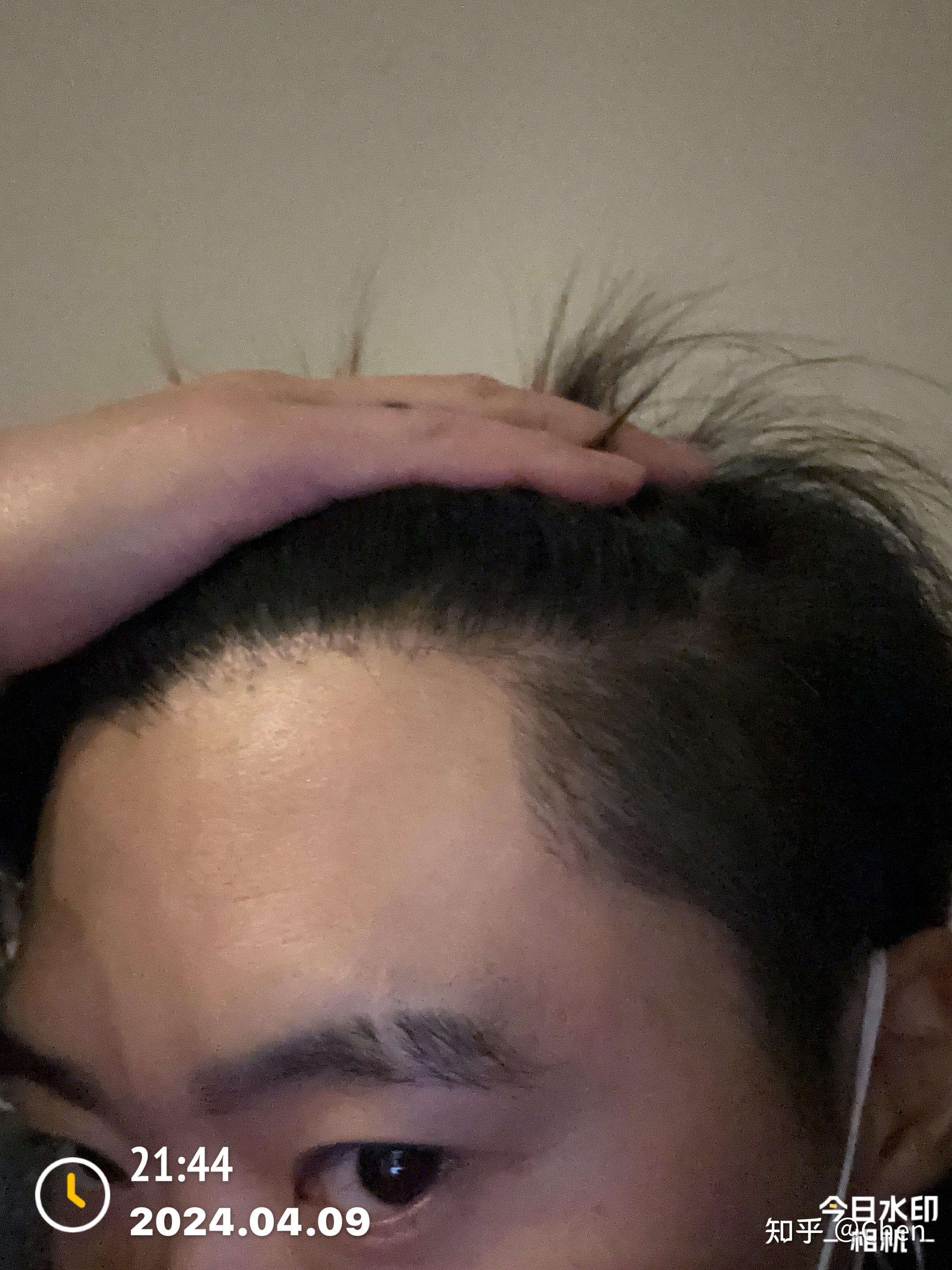 植发熬夜了(植发熬夜了会不长吗)