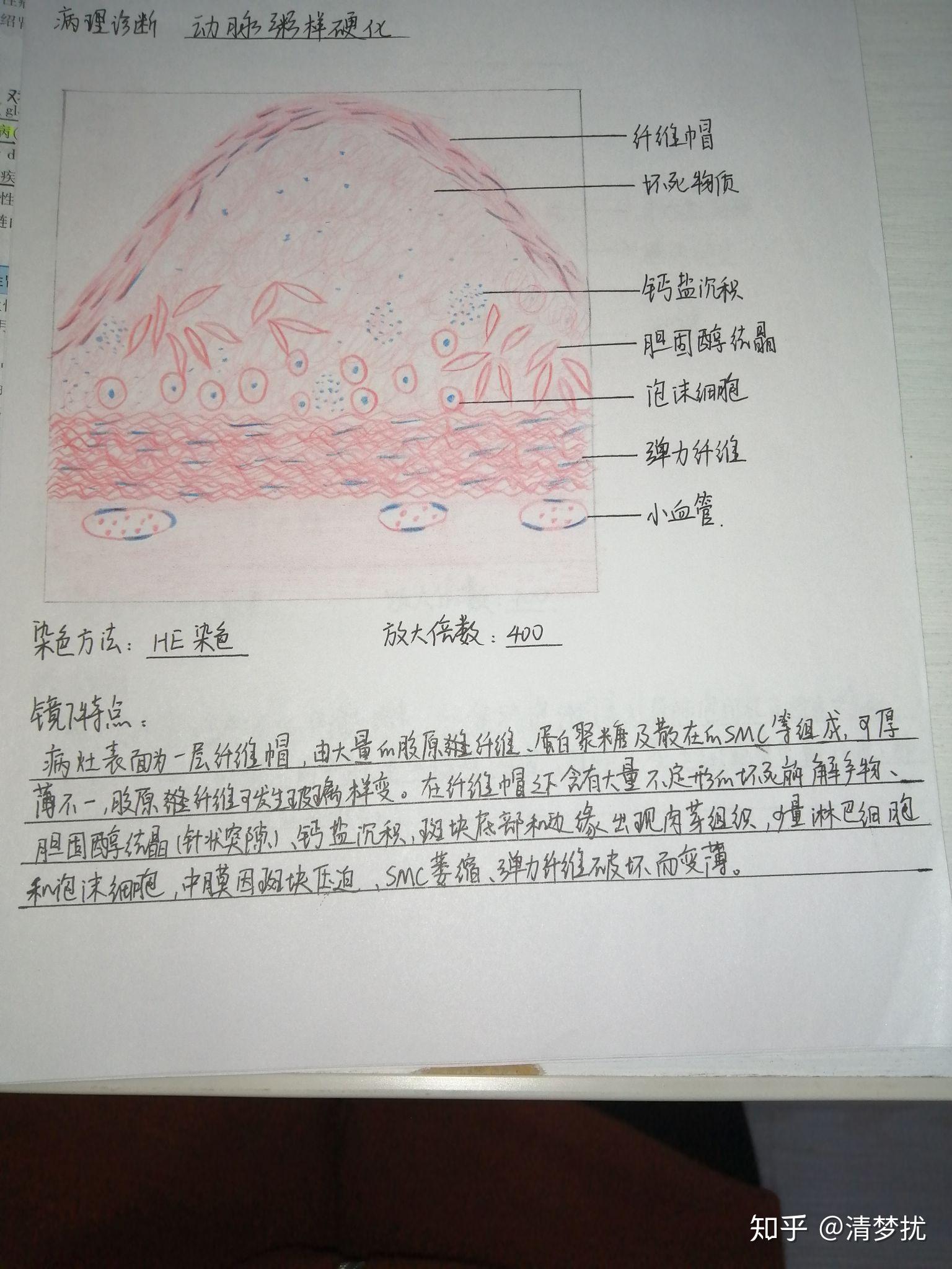 动脉粥样硬化4.鳞壮细胞癌3.平滑肌肉瘤2.各类炎细胞1.