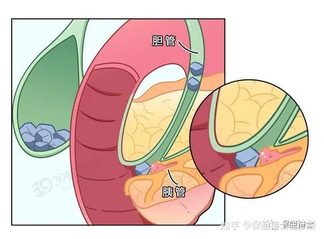 胰腺炎患者能否保胆取石
