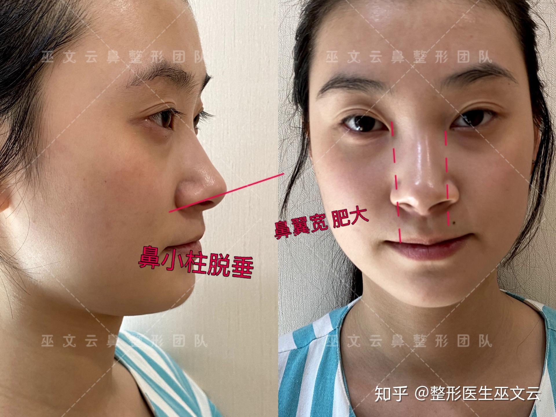 鼻翼挙上の料金や手術方法 |新宿と池袋の美容整形は東京シンデレラ美容外科