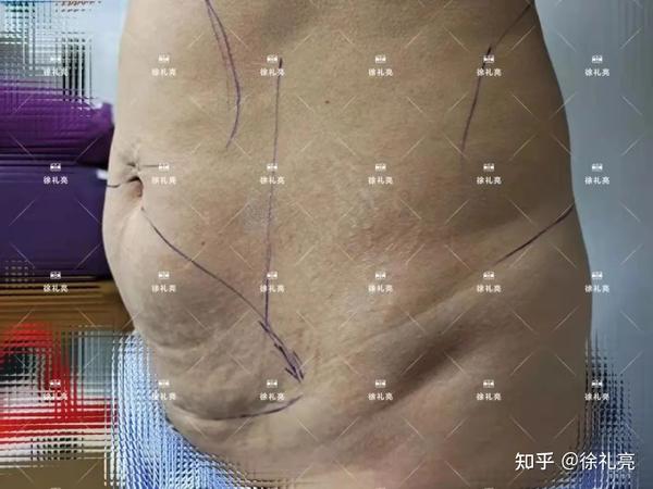 产后康复护理短视频制作 产后腹壁松弛,如何运动康复?