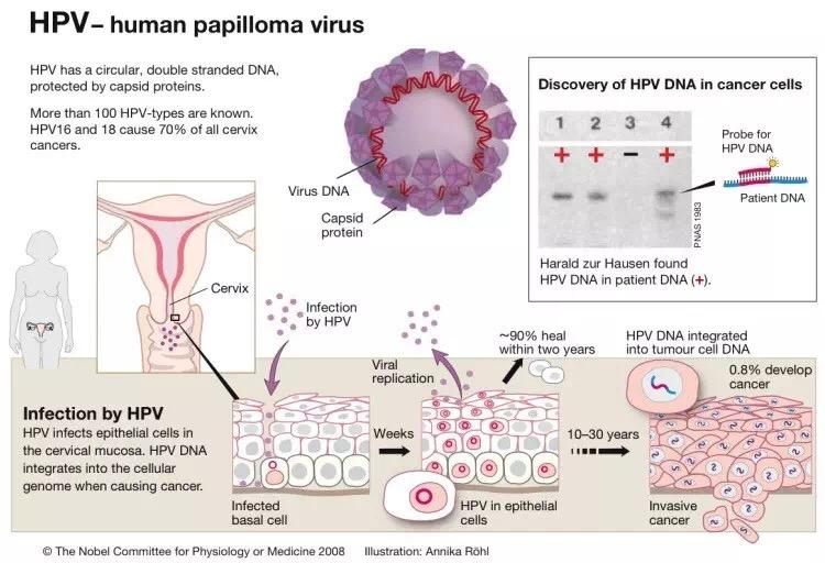 hpv人口_hpv症状图片