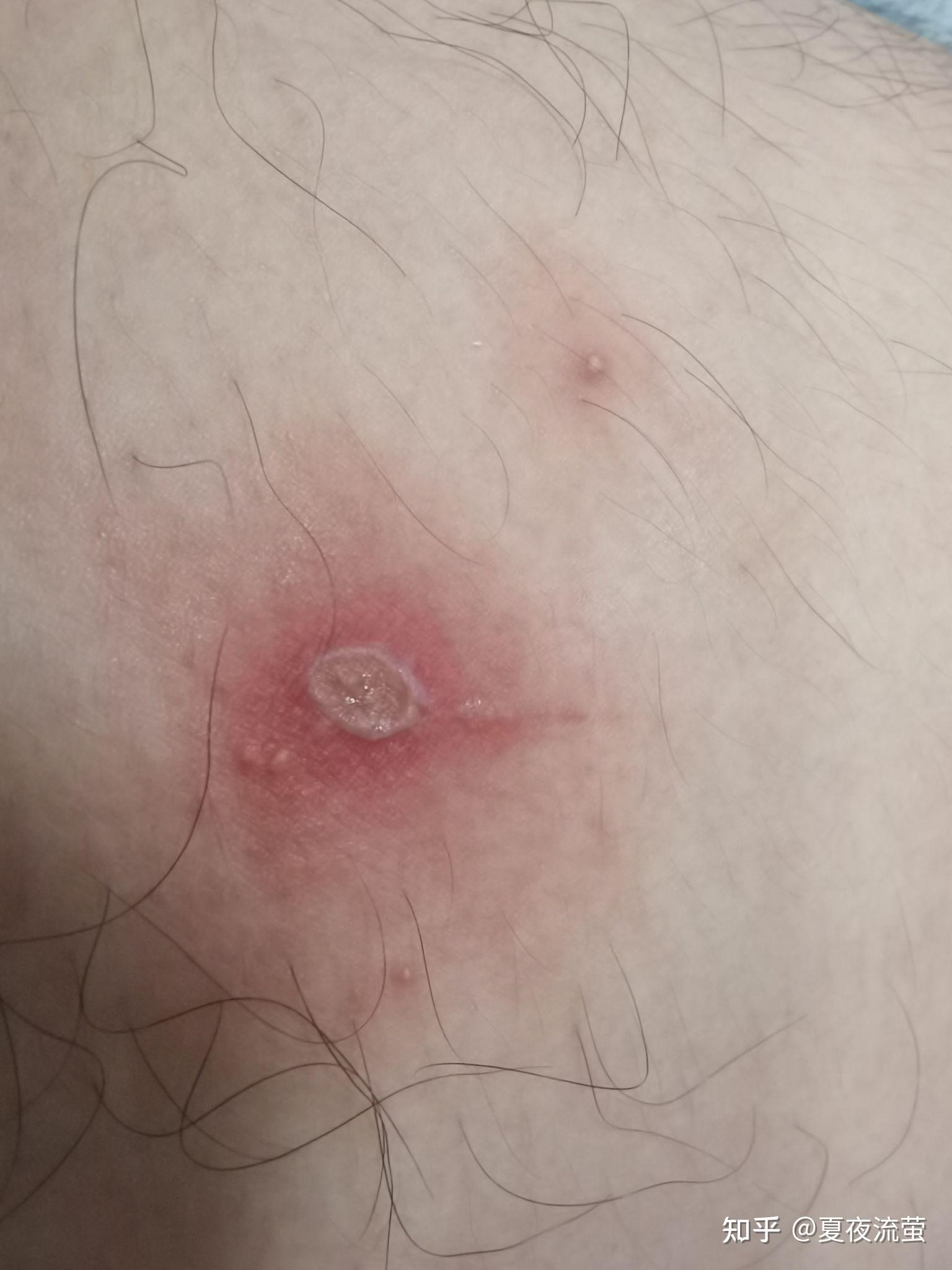 脓疱疮有图注意护眼