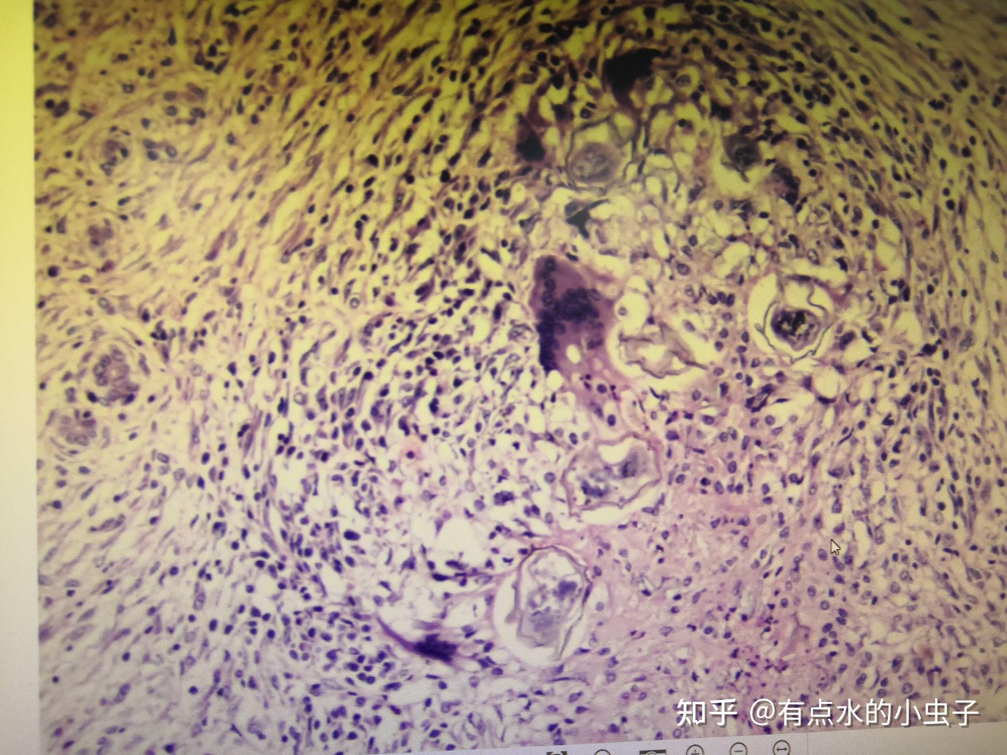 異物肉芽腫脾凝固性壞死(脾臟梗死)脾小動脈玻璃樣變肝脂肪變性子宮頸