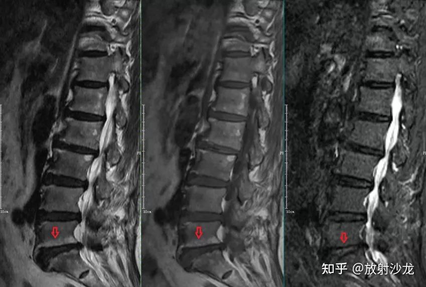 椎体终板炎 | 发生机制、分型以及 MRI 表现 - 知乎
