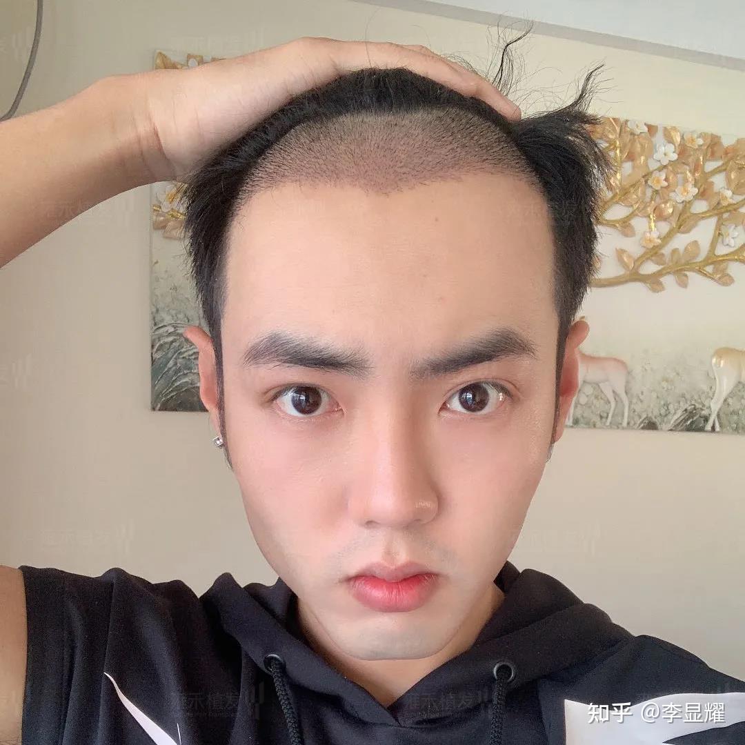 植发15天后的小泽,小发茬生长的很自然:泽说他把前面的头发放下来后