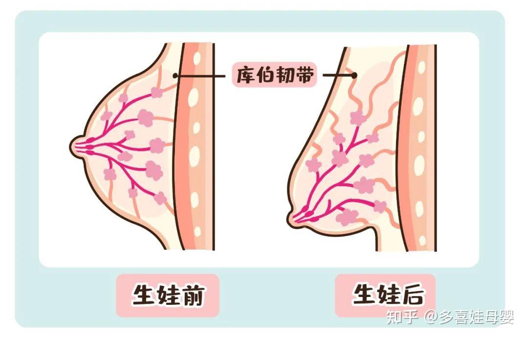 乳房脱垂图片