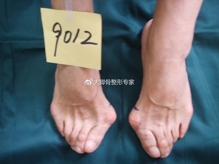 患上大脚骨怎么办 该如何矫正 知乎 患上大脚骨怎么办 该如何矫正 知乎
