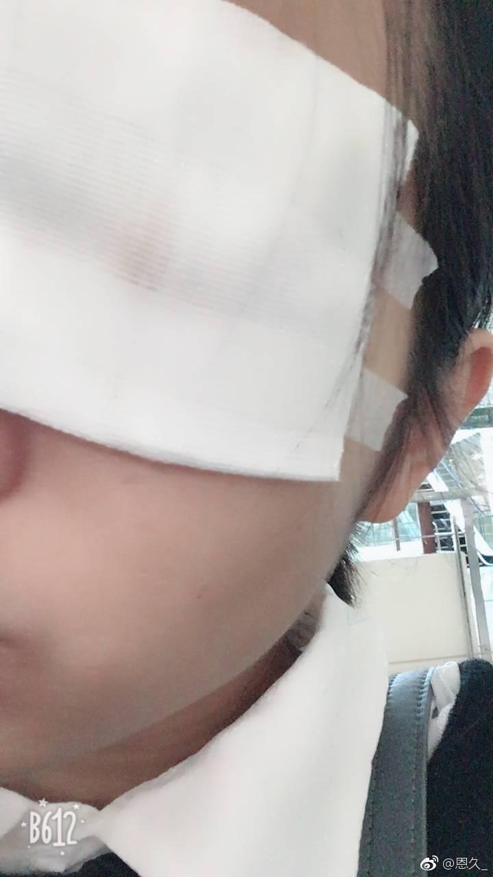 其实就差不多好了,就有点紫血,其实感觉自己都可以拆,拿棉签把血痂