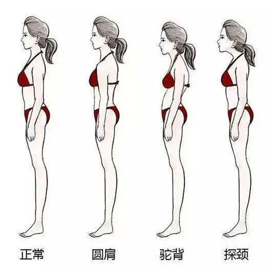 驼背 圆肩 脖子前倾 不良体态正在毁掉你的仙女气质 知乎