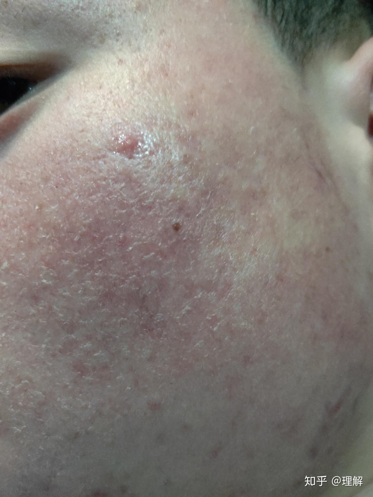 异维a酸软胶囊泰尔丝记录篇