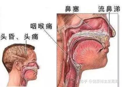 首大宋晓红 鼻窦发炎 眼 耳 口都可能被连累 知乎