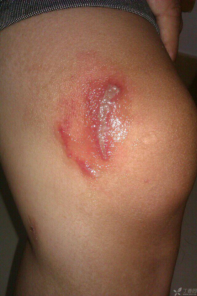 《睡梦拍"蚊子",醒来却毁容》 虫咬后刺痛或火烧样痛或剧痒,或者出现