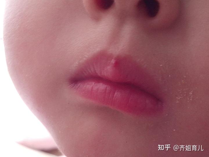 4,嘴唇发红因此,妈妈们要注意,一旦发现孩子近期较以往更容易感冒