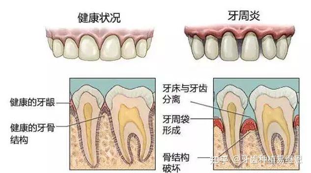 牙周炎太難了醫生不給我做牙齒矯正腫麼辦