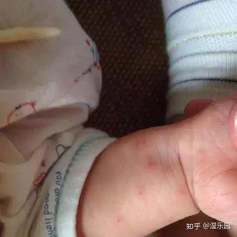 婴儿被蚊虫叮咬涂什么好