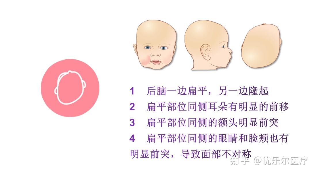 新生儿头颅畸形概念及分类 - 知乎
