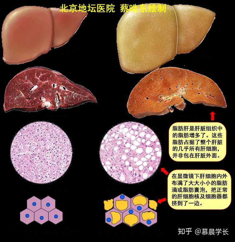 养肝护肝食谱_养肝护肝的食疗菜谱窍门_养肝护肝食谱一日三餐