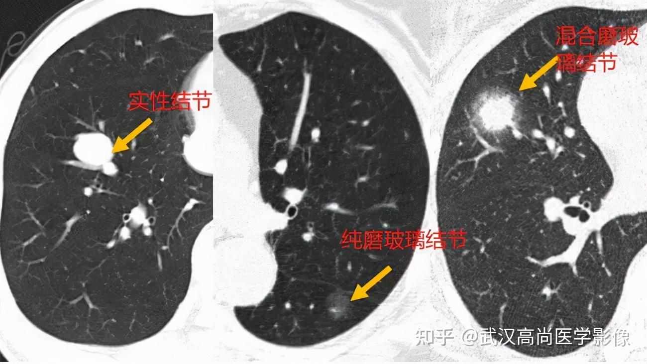 肺结节≠肺癌,定期ct检查心不慌【武汉高尚医学影像】