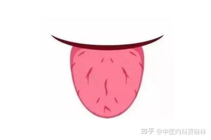 舌头中间有裂纹?警惕是这四种情况! - 知乎