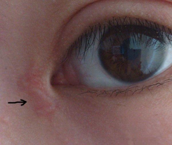 双眼皮的疤痕增生期一般发生在术后一个月到半年内 