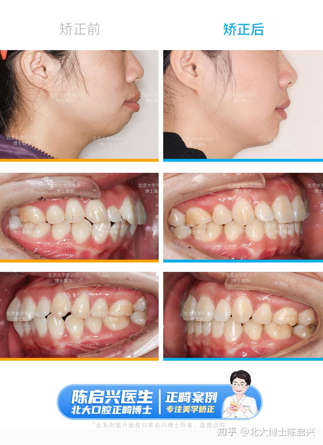 舌侧矫正改善骨性双颌前突案例 - 知乎