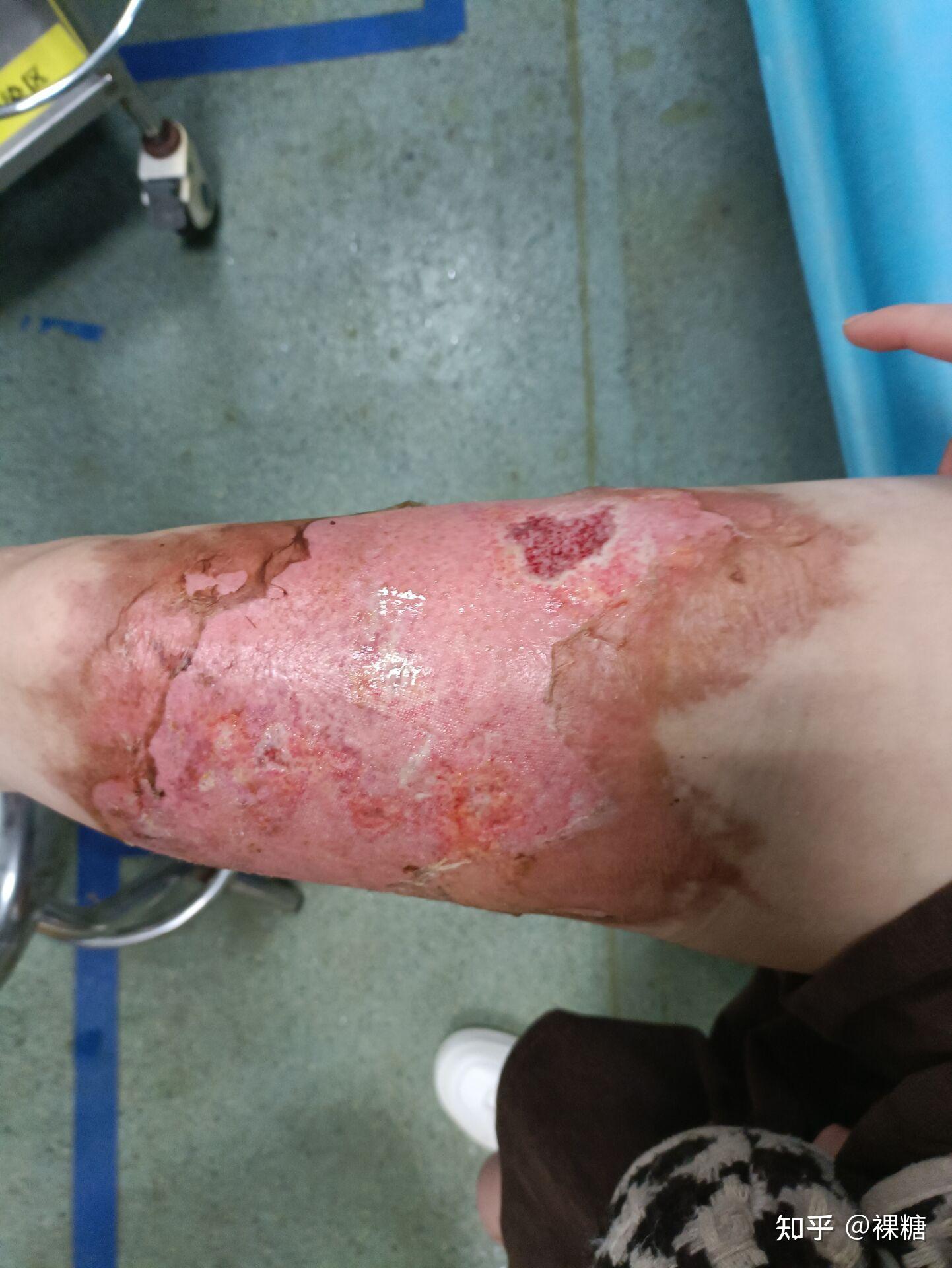 烫伤恢复记录 - 知乎