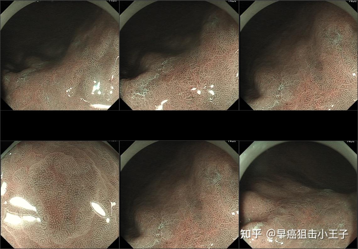 接近癌變,可考慮esd這次手邊沒有放大胃鏡,直接活檢