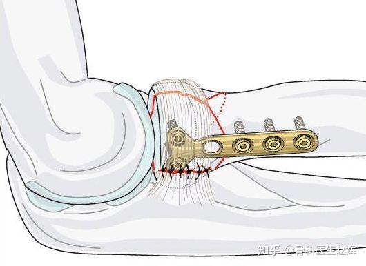 以免造成2次傷害.如大臂骨折取鋼板時就經常造成橈神經損傷.