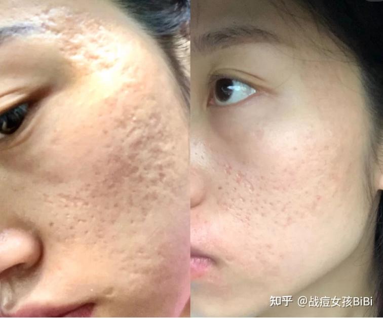 co2点阵激光治第一次痘坑治疗全记录