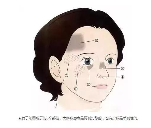 真皮斑褐青色斑