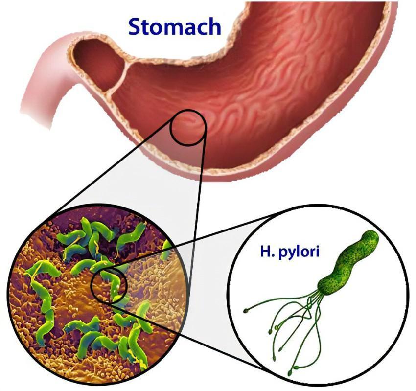 幽门螺杆菌,英文名helicobacterpylori,简称hpylori,在我国简称hp