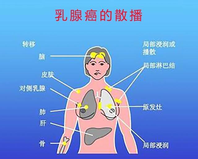 乳腺癌放疗该怎么做