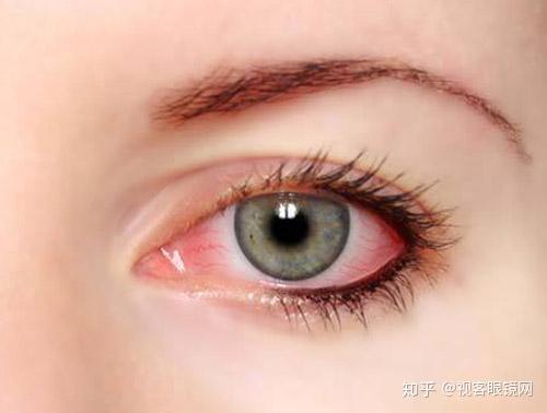 为什么隐形眼镜戴着老是感觉不舒服 知乎