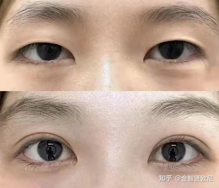 【双眼皮最全攻略】什么类型的双眼皮才适合你?不同术式该怎么选择?(全文干货) - 知乎