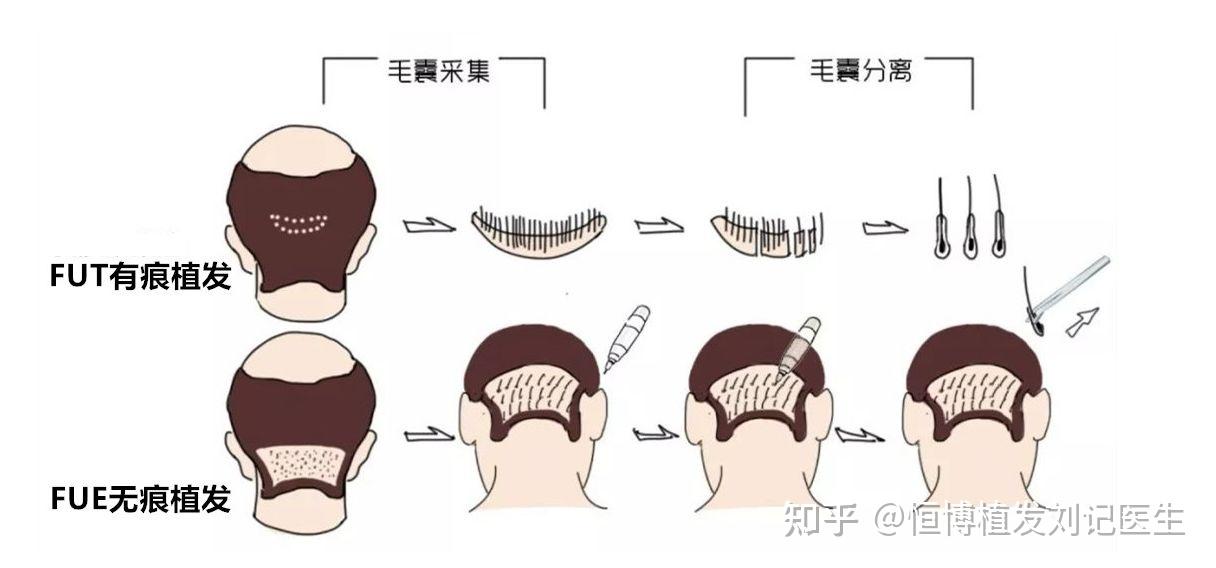 无痕植发