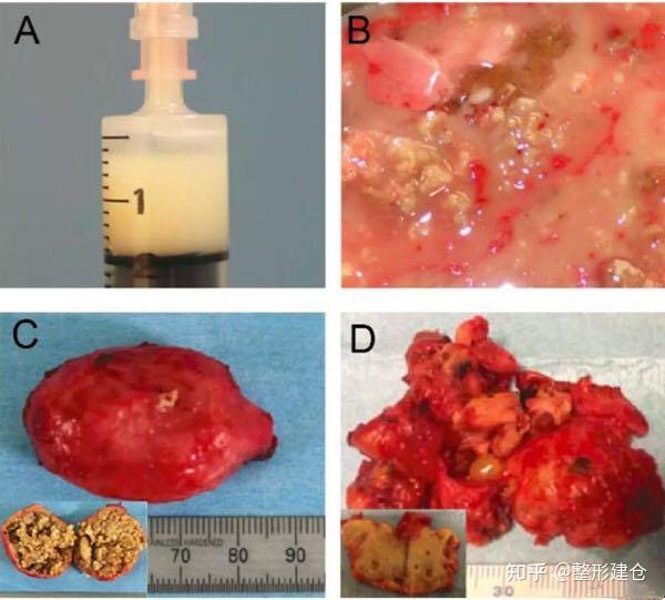 自体脂肪隆胸结节事宜细说