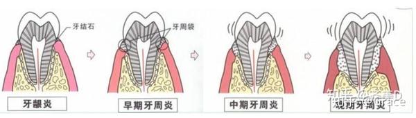 科普-牙周炎及治疗 - 知乎