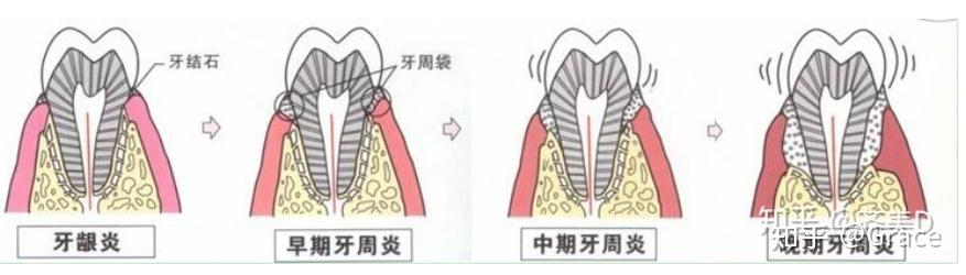 科普-牙周炎及治疗 - 知乎