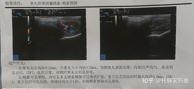 兵检检查出了精索静脉曲张为什么通过了?(图) - 知乎