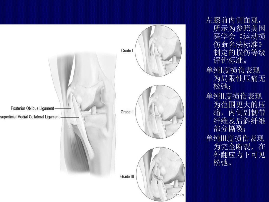 左膝外侧半月板撕裂+前交叉韧带断裂受伤经过及康复之路 - 知乎